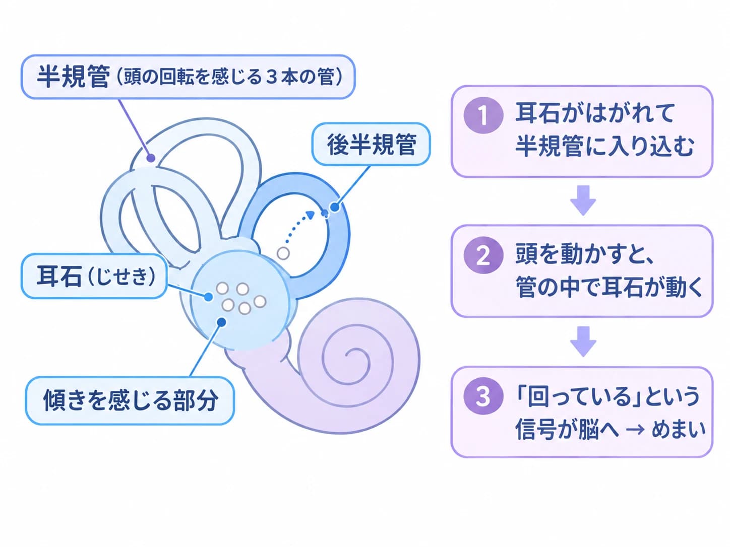 内耳の模式図。傾きを感じる部分の耳石がはがれて後半規管に入り込み、頭を動かすと管の中で耳石が動いて「回っている」という信号が脳へ送られ、めまいが起こる