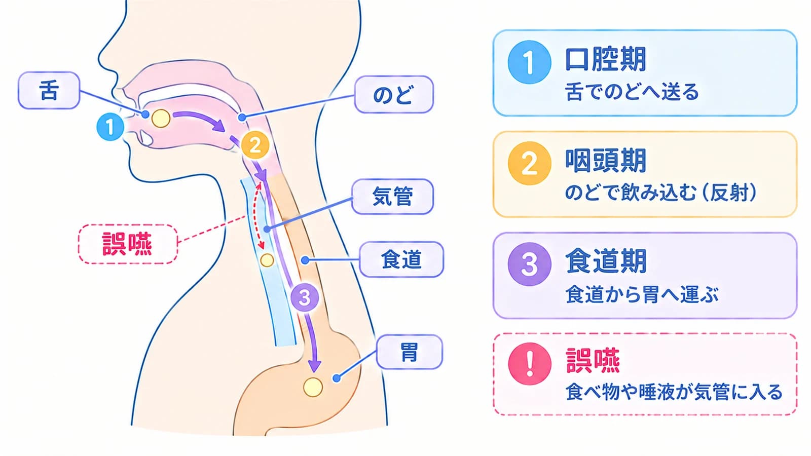 飲み込みの3つの段階。①口腔期は舌でのどへ送る、②咽頭期はのどで飲み込む(反射)、③食道期は食道から胃へ運ぶ。食べ物や唾液が気管に入るのが誤嚥