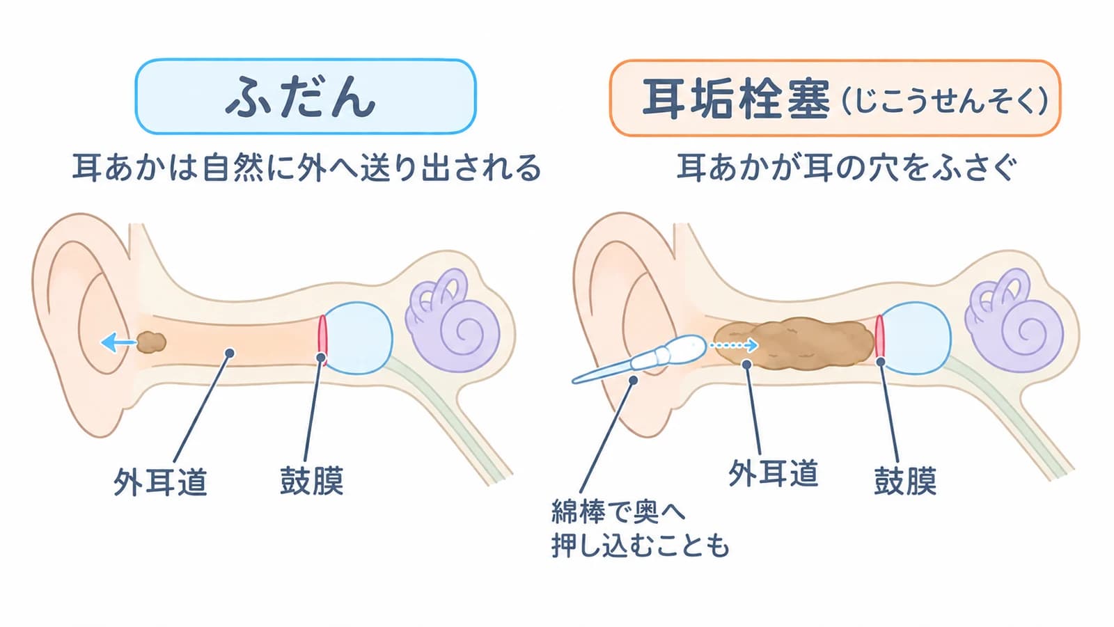 ふだんは耳あかが自然に外へ送り出される。耳垢栓塞は耳あかのかたまりが外耳道をふさぎ、綿棒で奥へ押し込んでしまうこともある