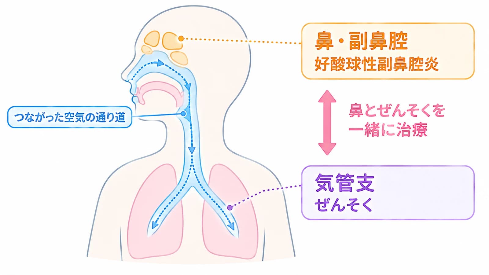 鼻・副鼻腔から気管支までは、つながった空気の通り道。鼻・副鼻腔の好酸球性副鼻腔炎と、気管支喘息を一緒に治療する