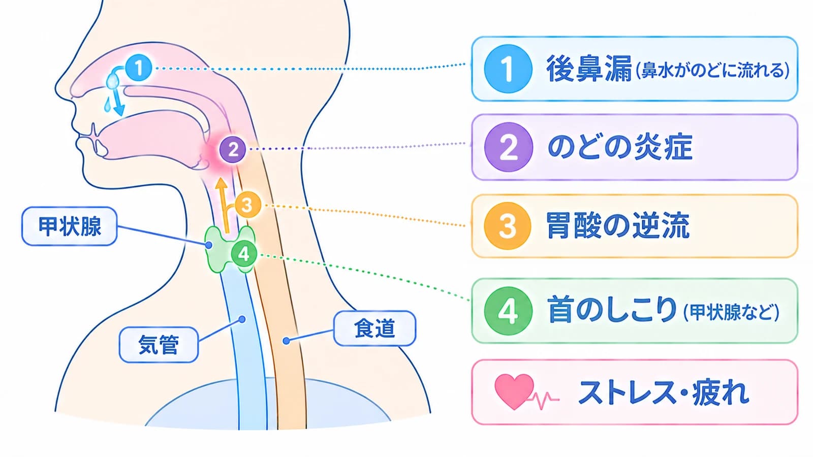 のどの違和感の主な原因と場所。①鼻の奥からのどへ流れる後鼻漏、②のどの炎症、③食道からの胃酸の逆流、④甲状腺などの首のしこり。ストレス・疲れも原因になる(⑤のどの腫瘍は図に含めていない)