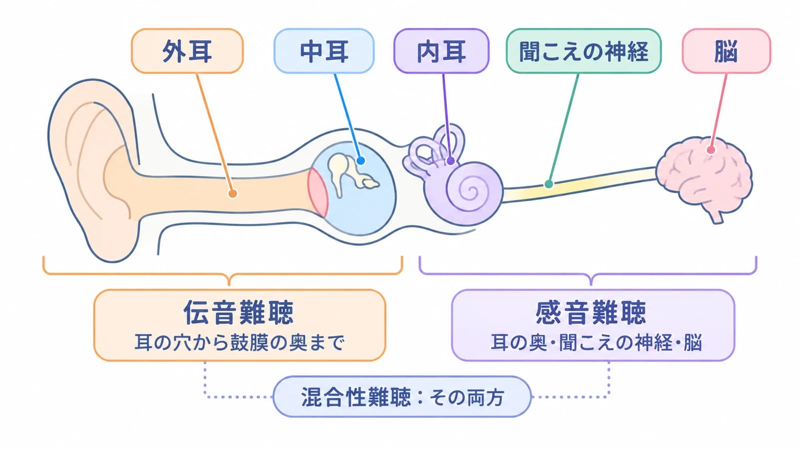 耳から脳までの図。外耳・中耳に原因があるのが伝音難聴、内耳・聞こえの神経・脳に原因があるのが感音難聴、その両方が混合性難聴