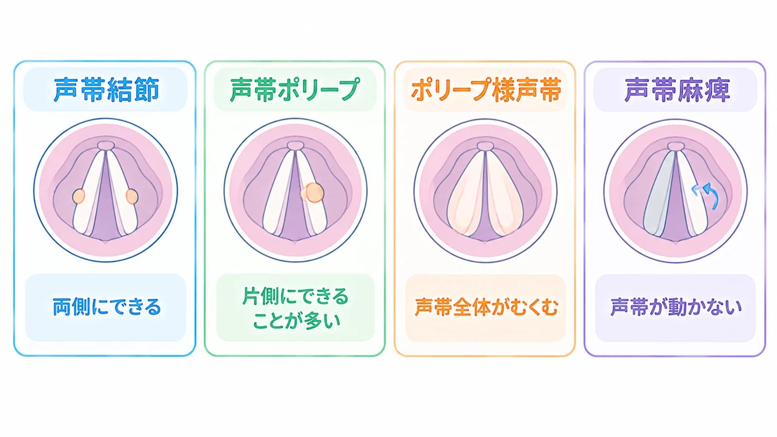 喉頭を上から見た声帯の4つの病気の比較。声帯結節は両側にできる、声帯ポリープは片側にできることが多い、ポリープ様声帯は声帯全体がむくむ、声帯麻痺は声帯が動かない
