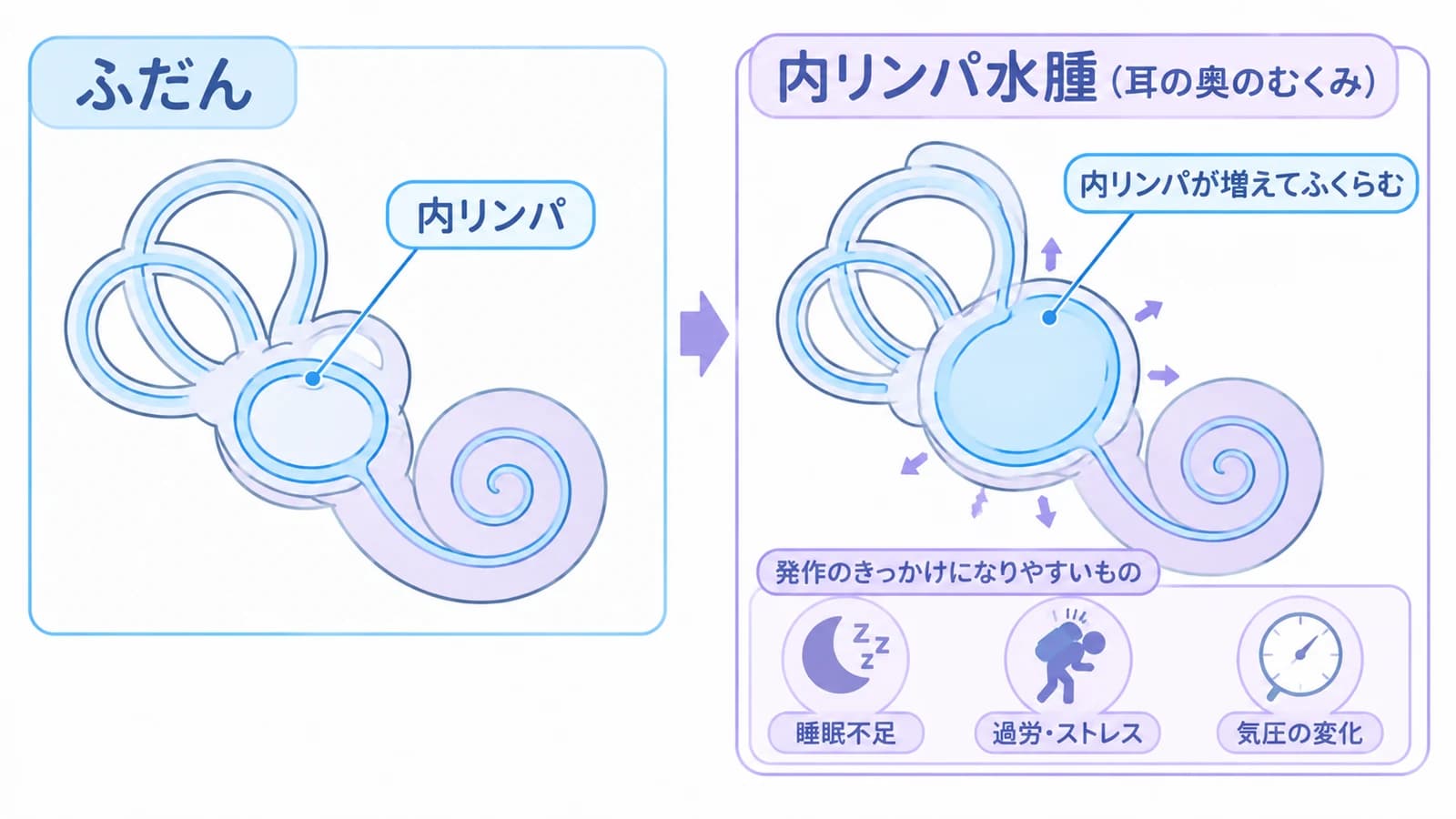 内耳の比較。ふだんの内リンパと、内リンパが増えてふくらんだ内リンパ水腫。発作のきっかけになりやすいものは睡眠不足、過労・ストレス、気圧の変化