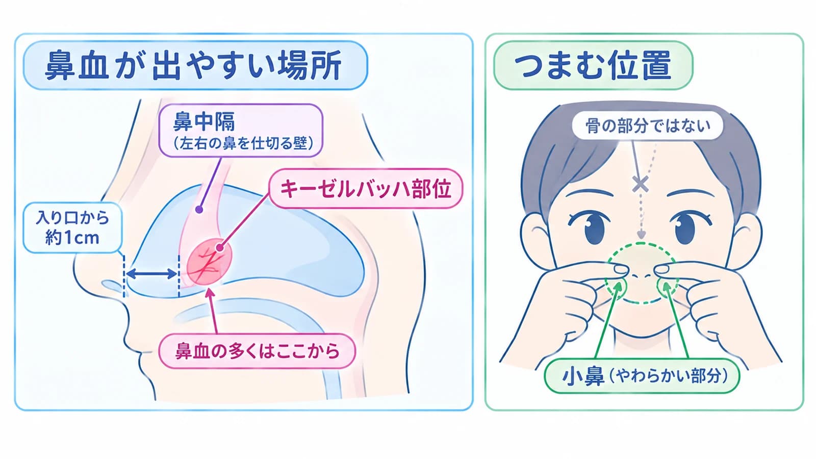鼻血が出やすい場所とつまむ位置。鼻の入り口から約1cm奥の鼻中隔にあるキーゼルバッハ部位から、鼻血の多くは出る。止めるときは骨の部分ではなく、小鼻(やわらかい部分)をつまむ