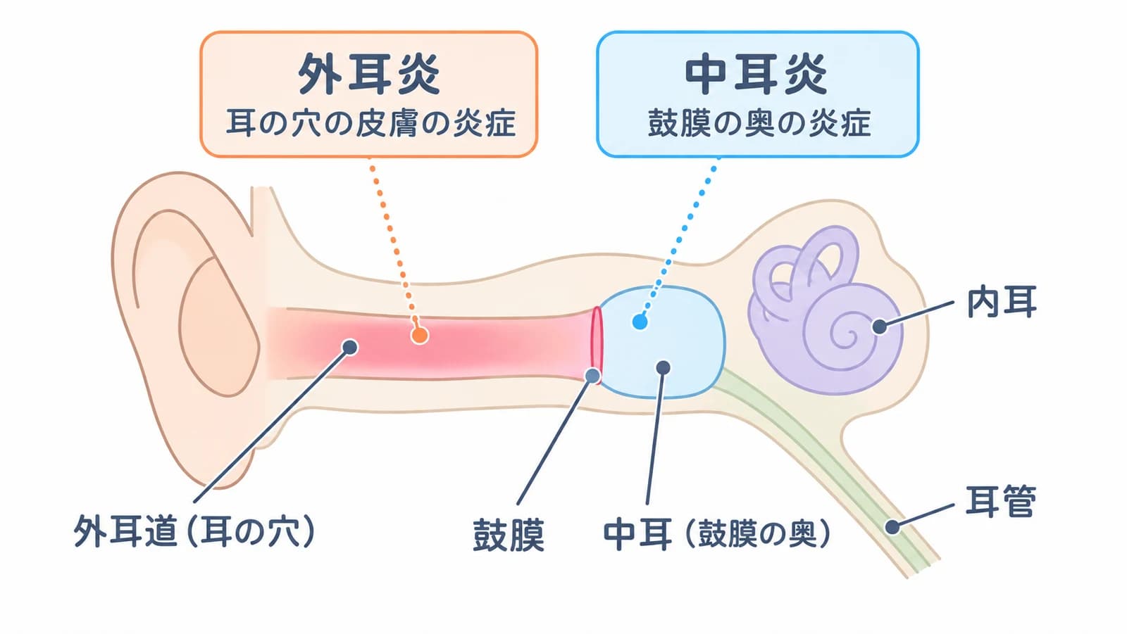 外耳炎と中耳炎の起こる場所。外耳道(耳の穴)の皮膚の炎症が外耳炎、鼓膜の奥の中耳の炎症が中耳炎