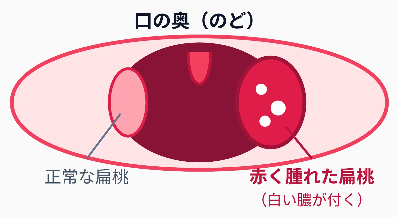 口の奥(のど)の図。正常な扁桃と、白い膿が付いて赤く腫れた扁桃