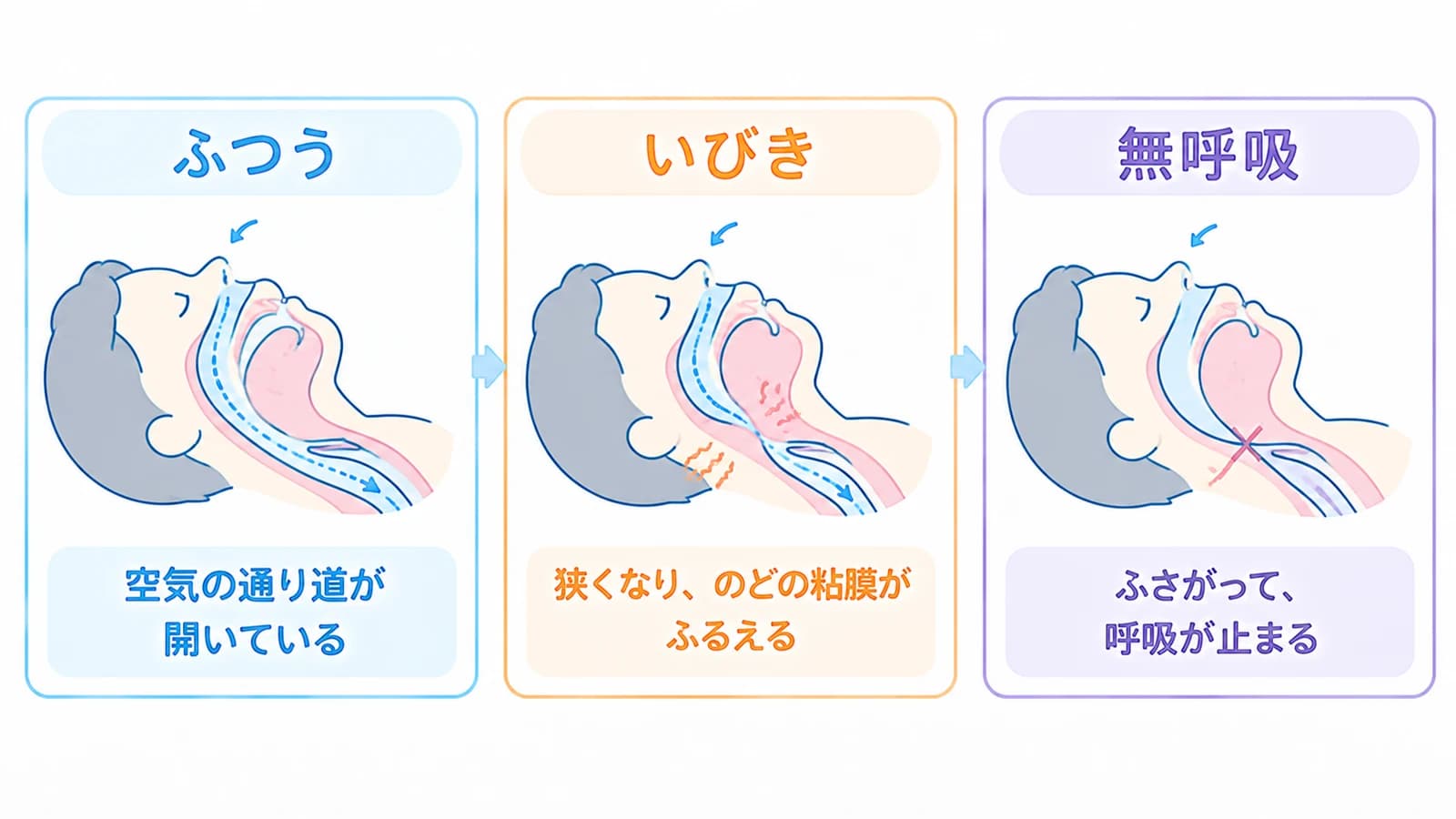 眠っているときの、のどの空気の通り道の3つの状態。ふつうは通り道が開いている。いびきは狭くなり、のどの粘膜がふるえる。無呼吸はふさがって呼吸が止まる