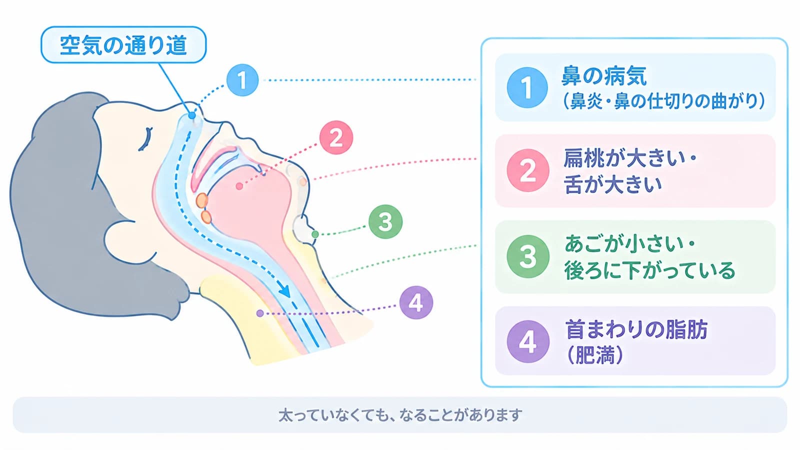 空気の通り道が狭くなる主な原因4つを、頭から首の断面図で示した図。鼻の病気(鼻炎・鼻の仕切りの曲がり)、扁桃や舌が大きい、あごが小さい・後ろに下がっている、首まわりの脂肪(肥満)