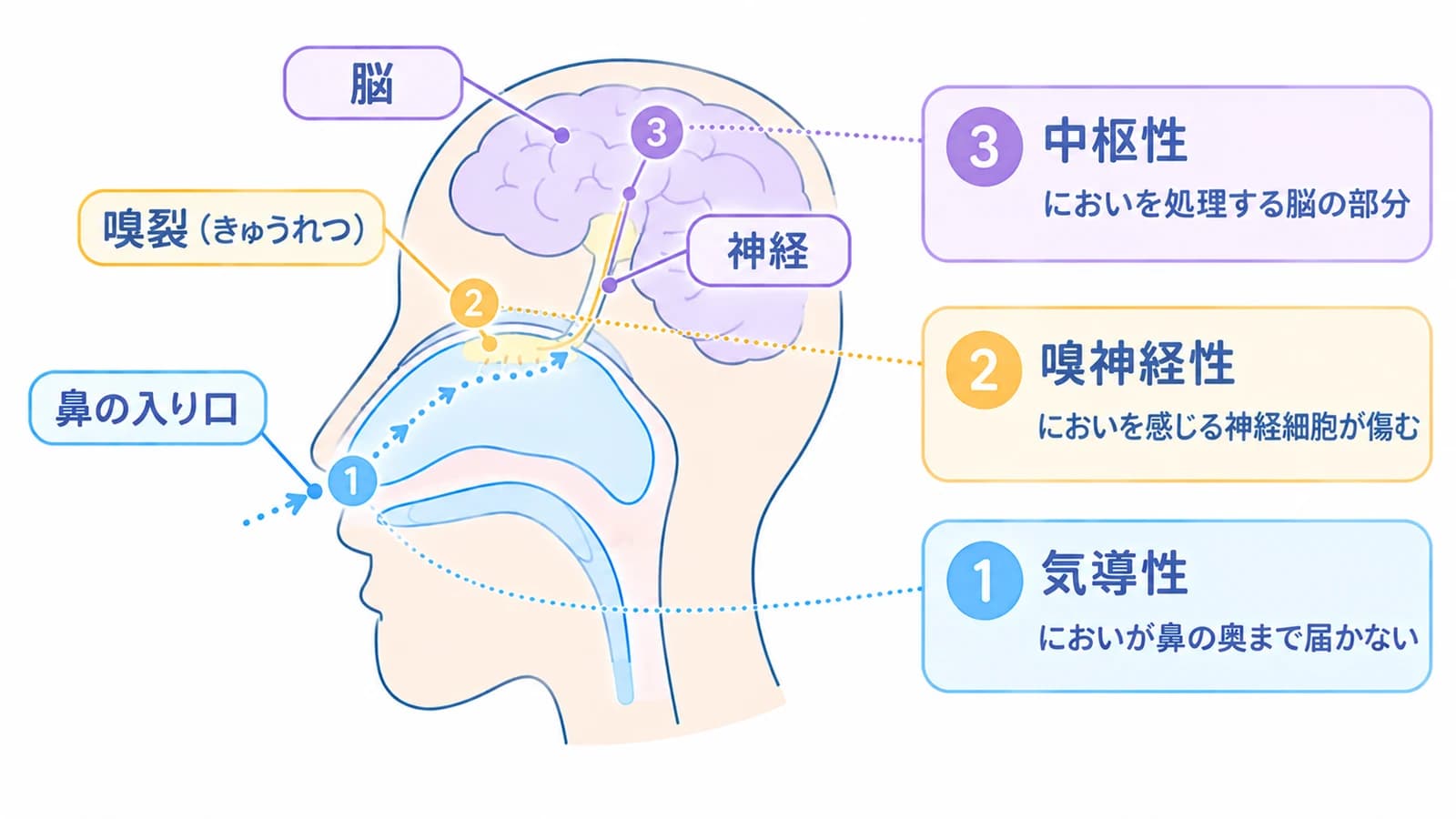 においの通り道の図。鼻の入り口から嗅裂、神経を通って脳へ伝わる。①気導性はにおいが鼻の奥まで届かない、②嗅神経性はにおいを感じる神経細胞が傷む、③中枢性はにおいを処理する脳の部分